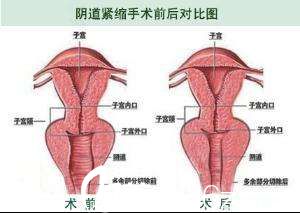 阴道缩紧术前后对比