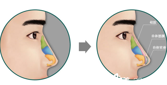 北京欧芭丽格医疗美容鼻部整形示意图