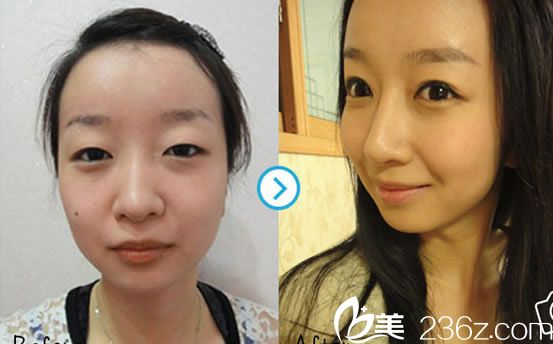 张小红院长的双眼皮案例图