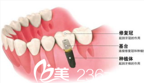 北京大学口腔医院种植牙示意图